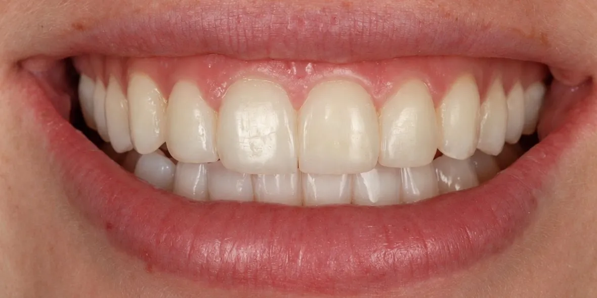 After: edge bonding once Invisalign had straightened the teeth