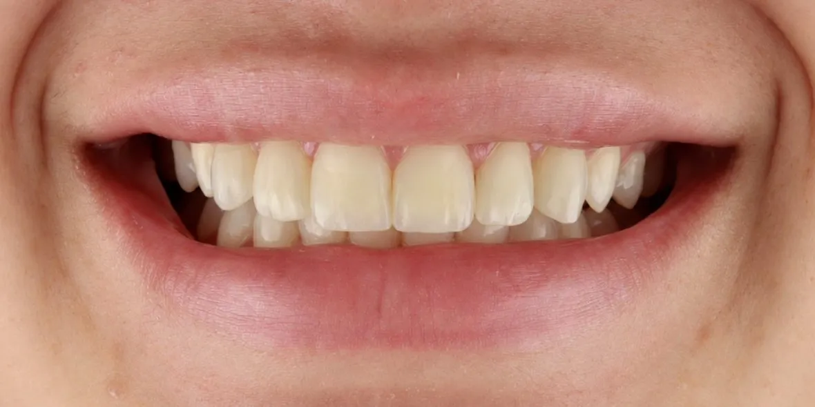 After: tooth proportions rebalanced, spaces closed and white and dark marks hidden with bonding