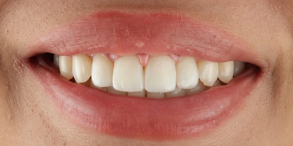 After: the gap between the top front teeth closed with Invisalign