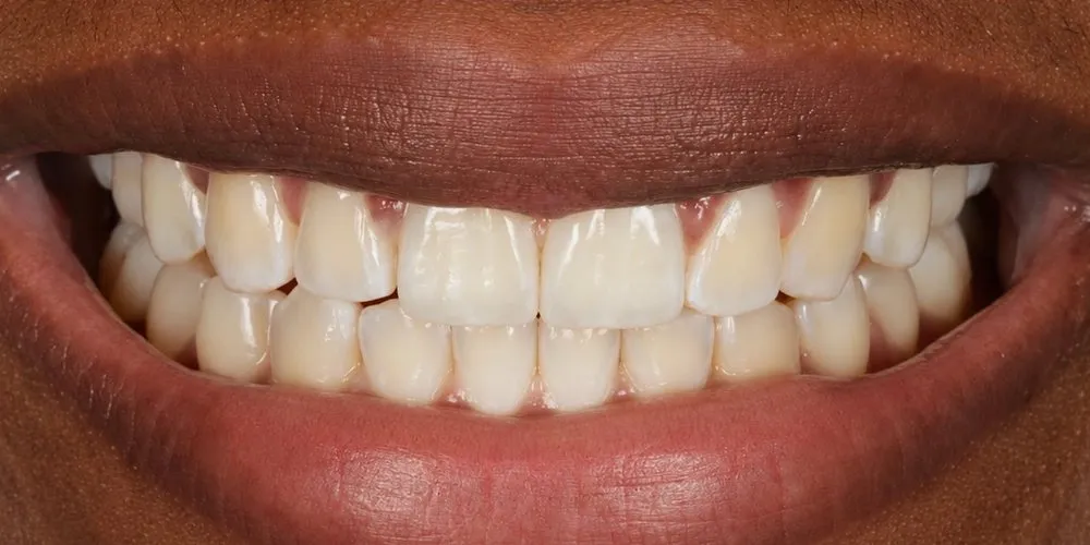 After: space between the upper front teeth closed with aligners