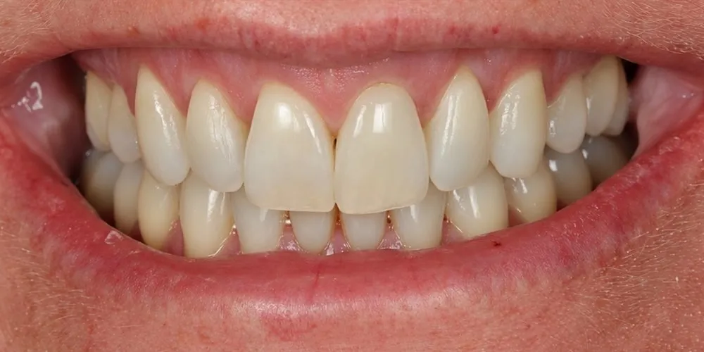 After: crowded front teeth that leaned inwards, aligned with Invisalign