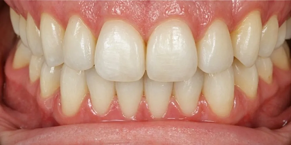 After: open bite and crossbites at the front and sides corrected with Invisalign