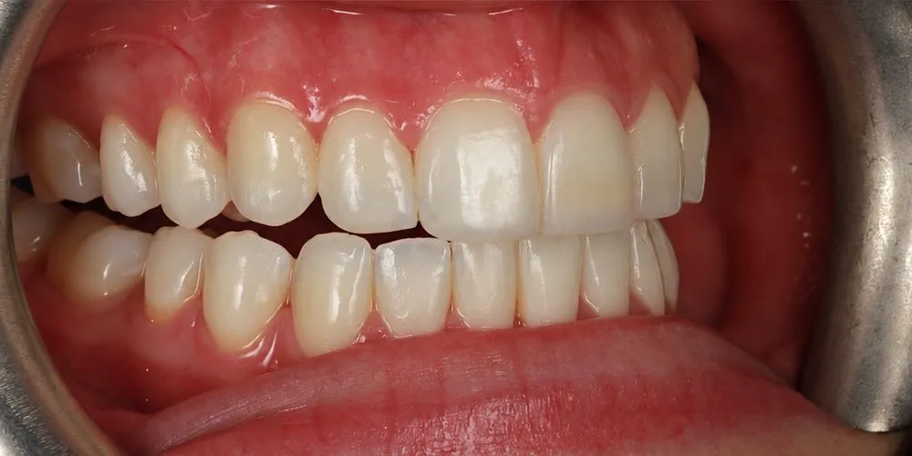 After: crowding that returned after braces corrected with Invisalign, then edge bonding on four upper teeth