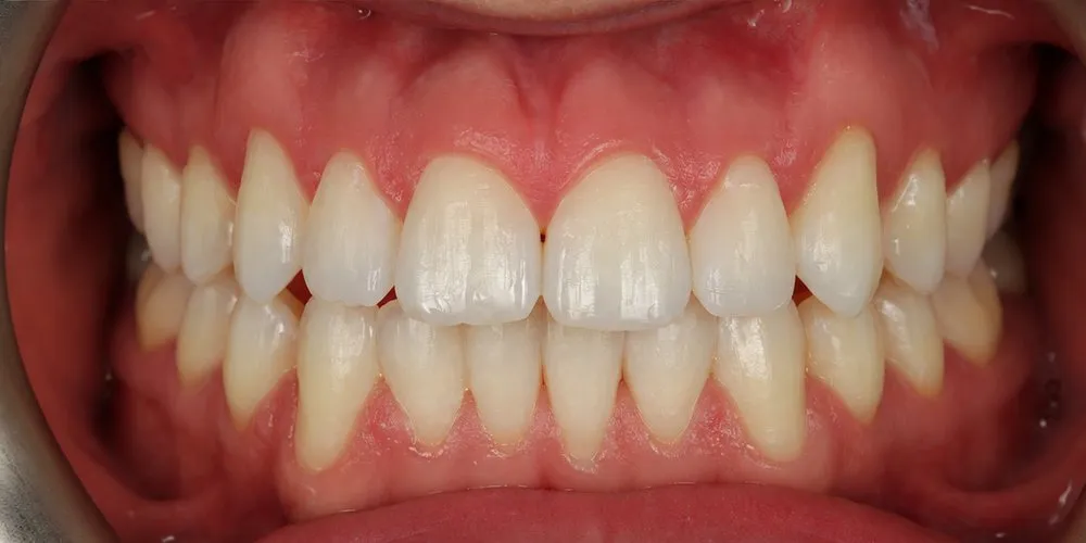 After: open bite, outward-sitting canines and crowding corrected with Invisalign