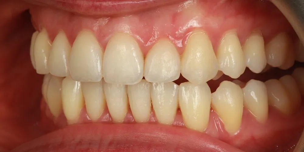 After: protruding, crowded upper teeth and a rotated front tooth straightened with Invisalign