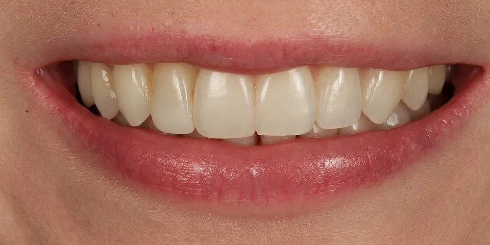After: Class II division 2 bite and a peg-shaped side tooth treated with Invisalign
