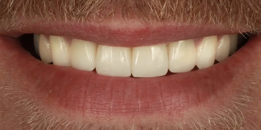 After: smile makeover combining Invisalign, implants and veneers