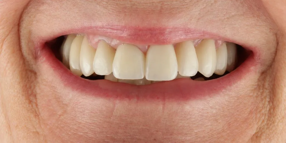 After: failing restorations replaced with veneers, crowns and bridges