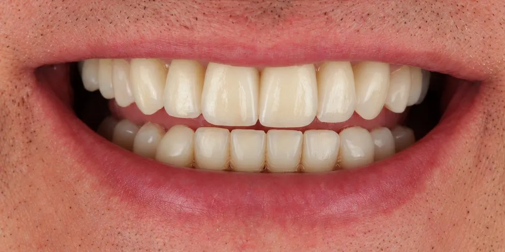 After: smile reshaped and brightened with veneers