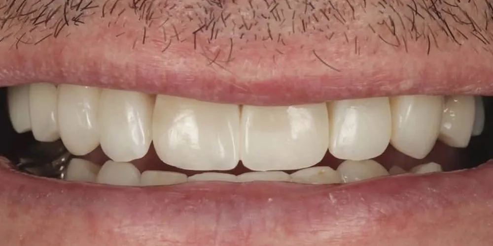 After: full mouth rehabilitation