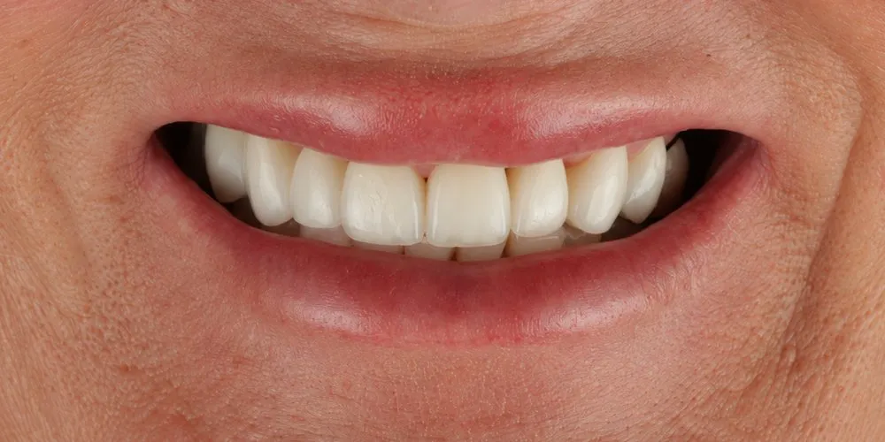 After: crowns, veneers and bridges replacing old restorations and missing teeth